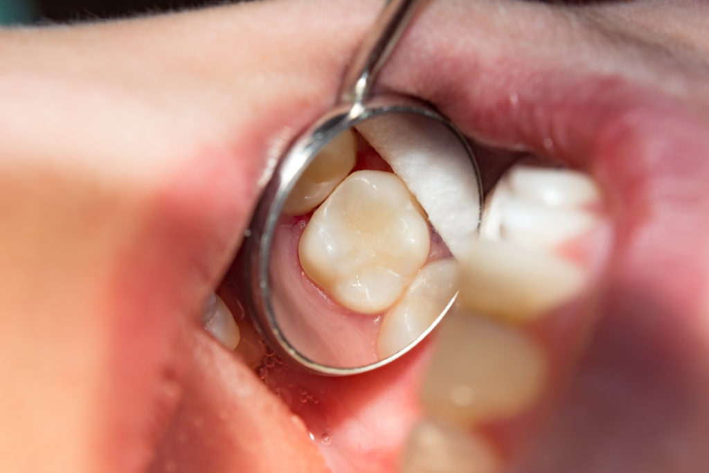 How Much Does Cavity Filling Cost