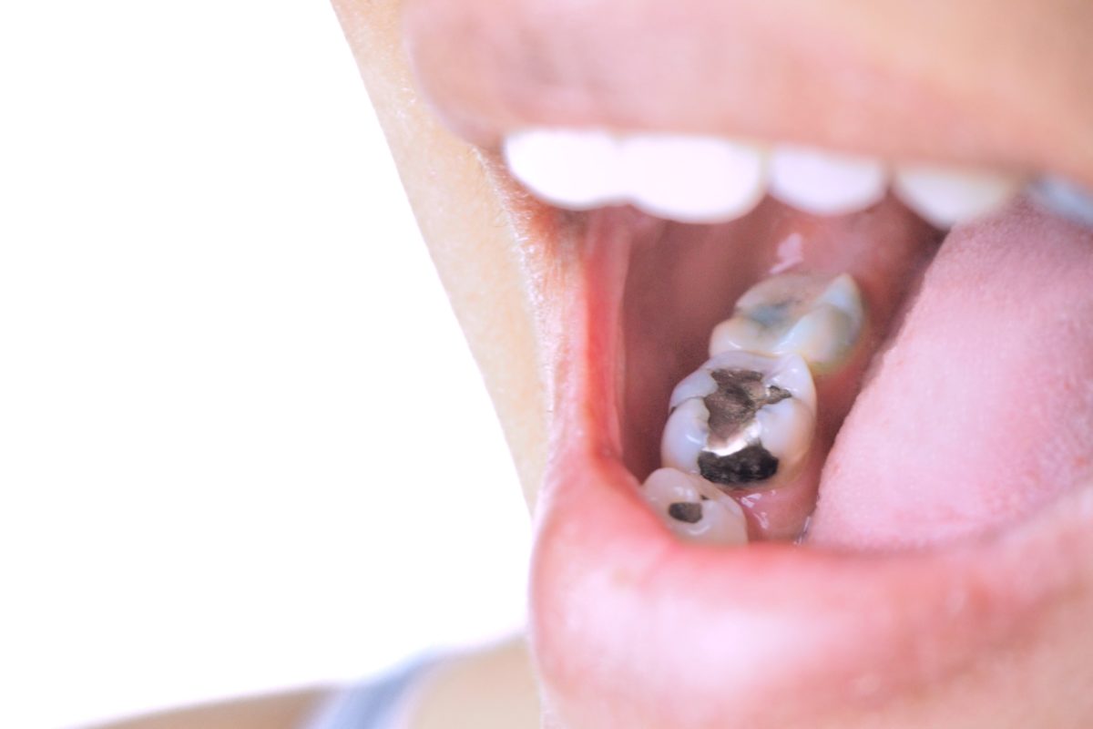 How Much Does Dental Filling Cost