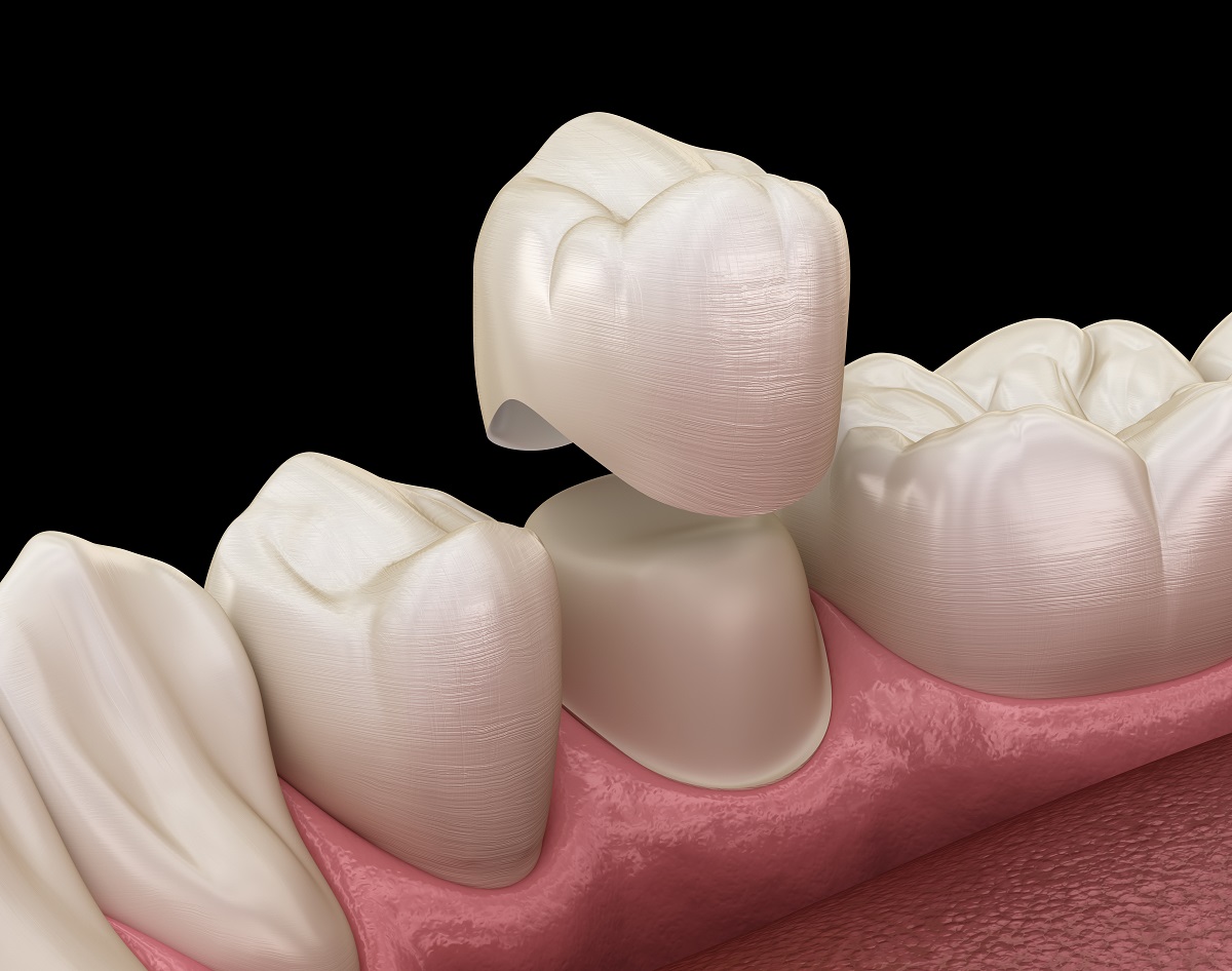 Tooth crown