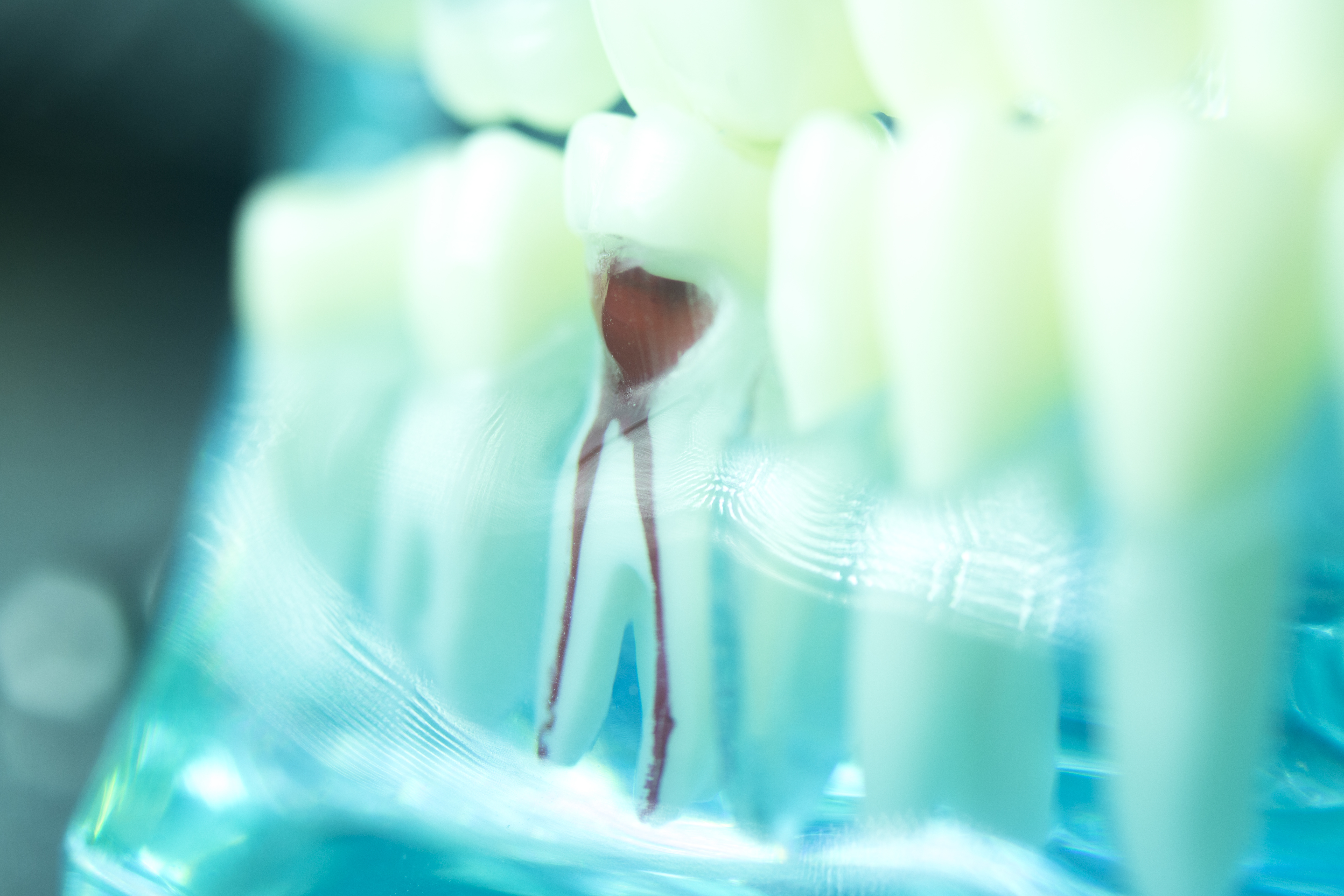 How Much Does Treatment for Root Canal Cost?