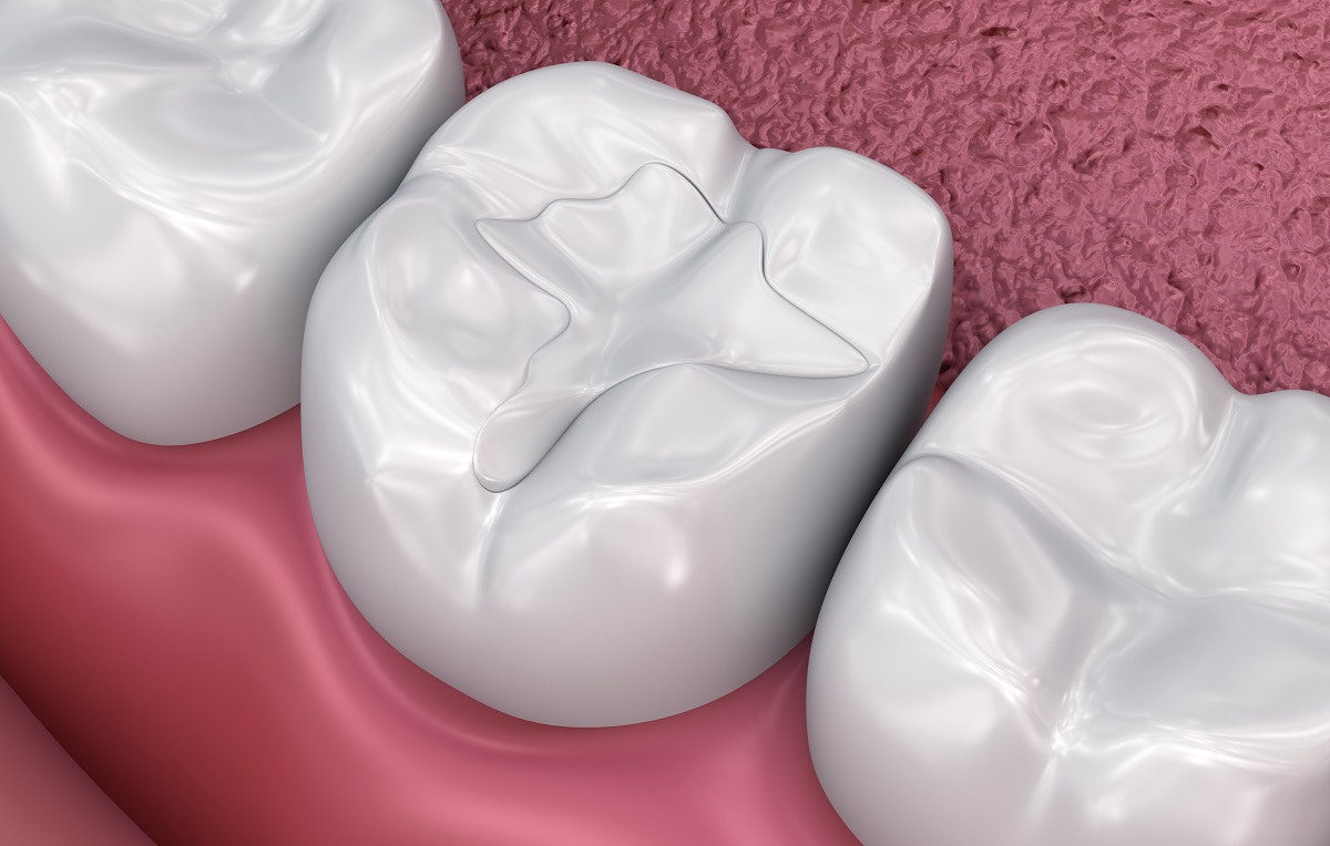 Dental Fillings