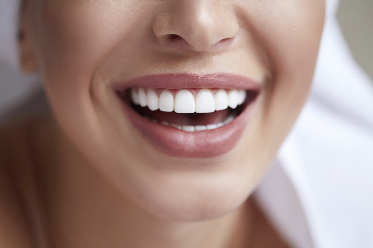 Teeth Whitening Cost
