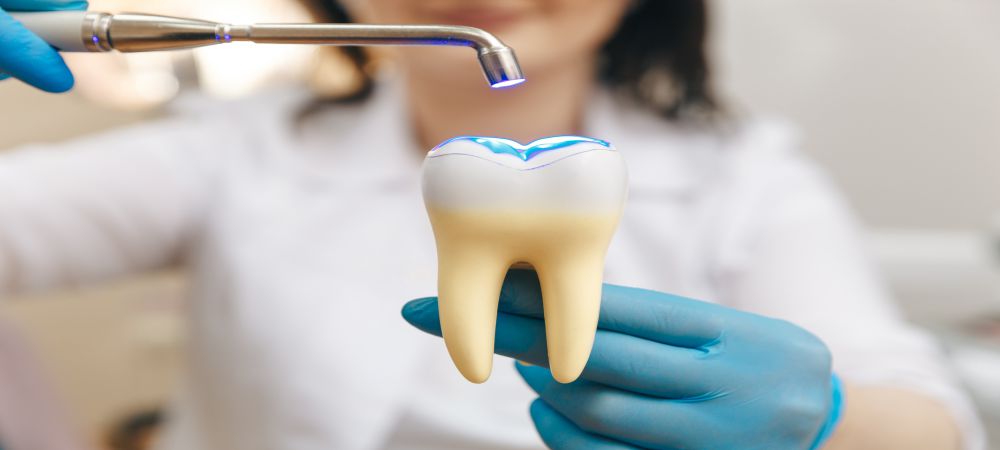 dental fillings