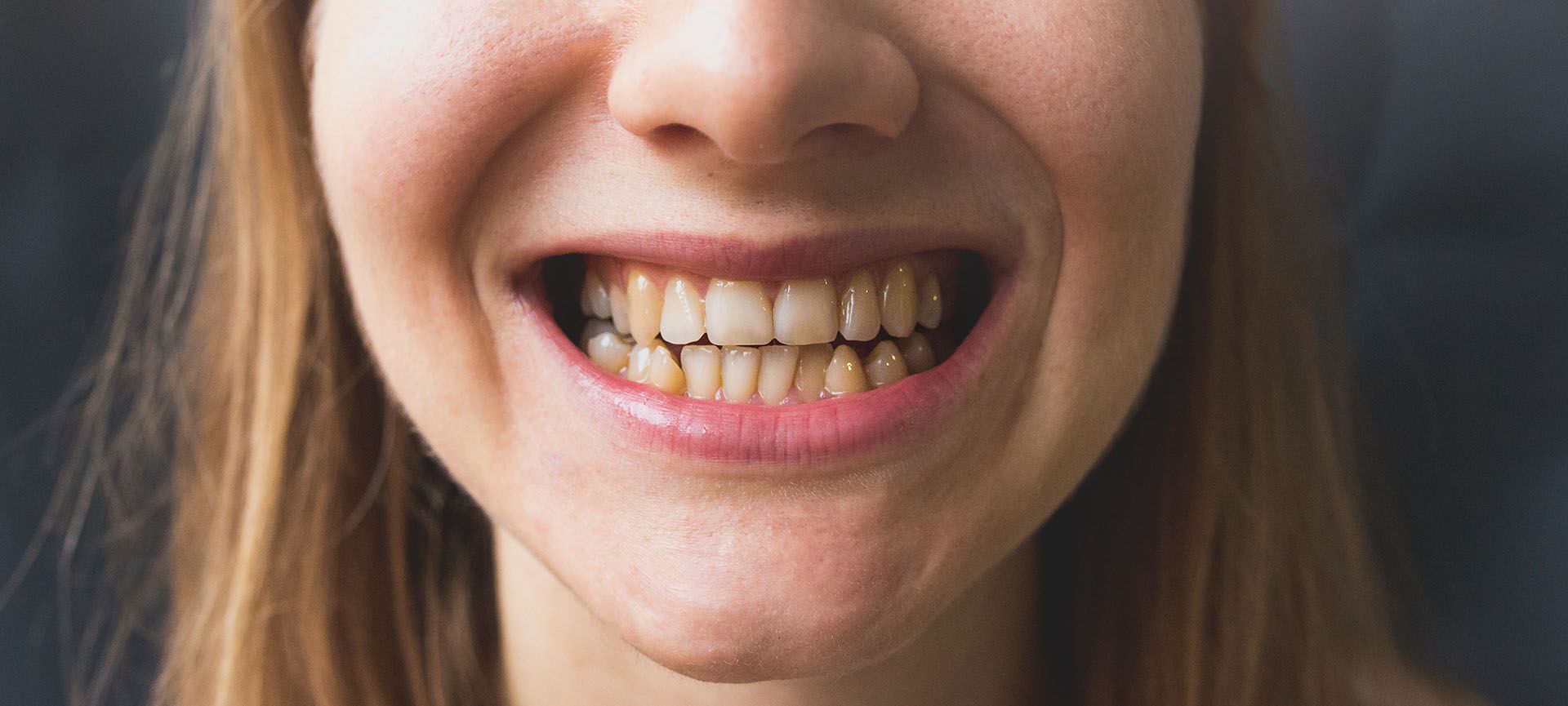 restore bad teeth