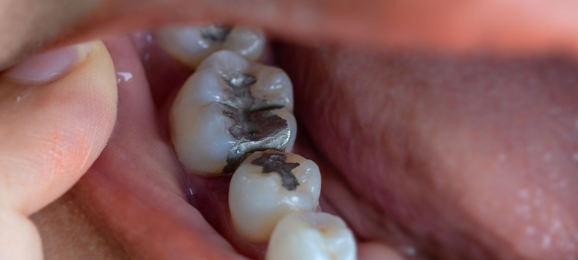 tooth filling
