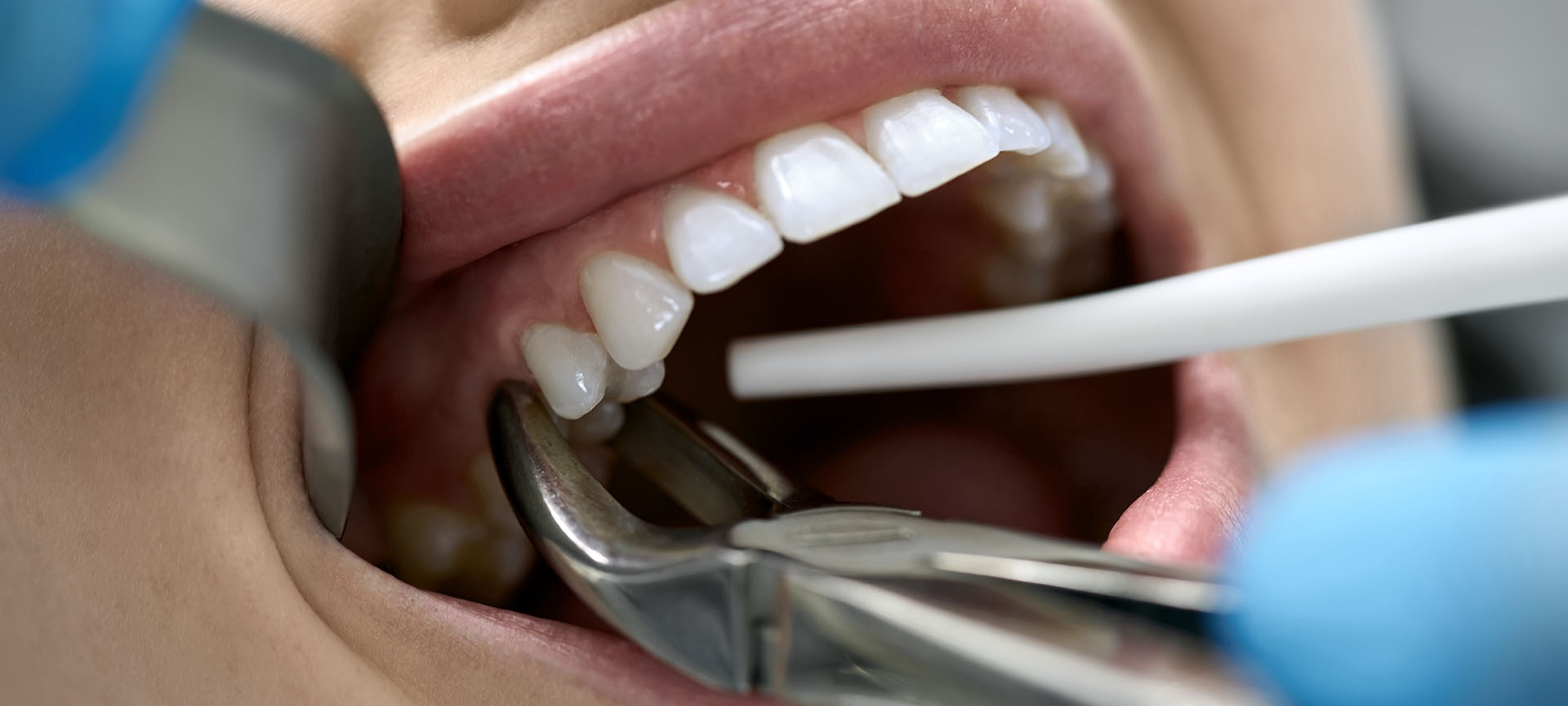 tooth extraction to heal