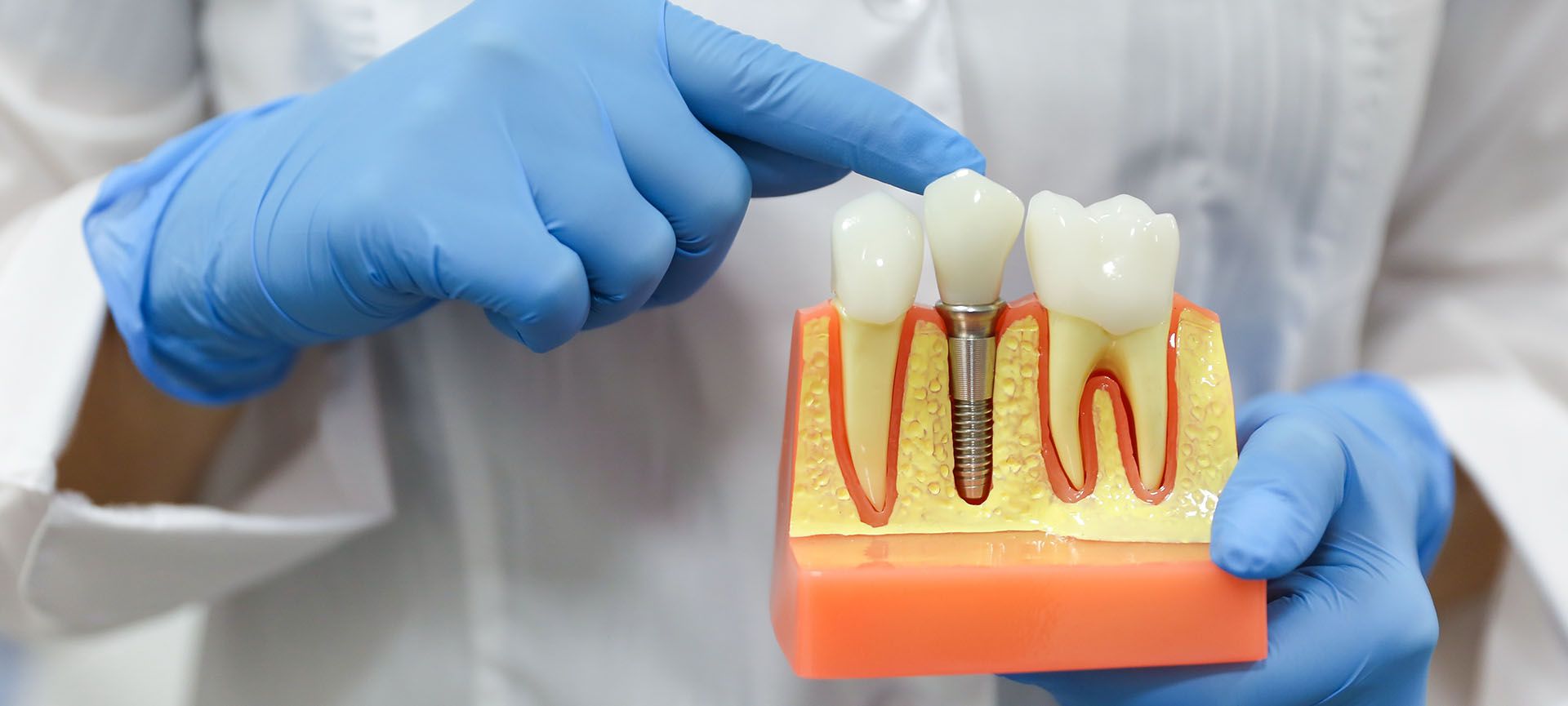 dental implants