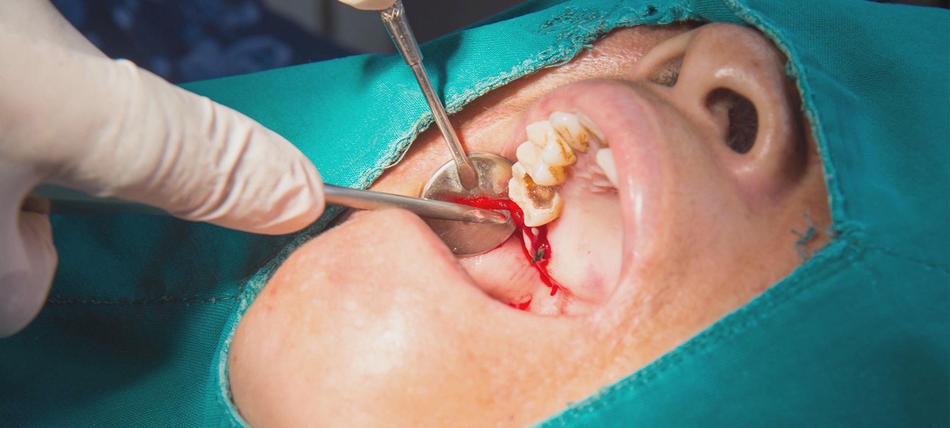 after wisdom tooth removal