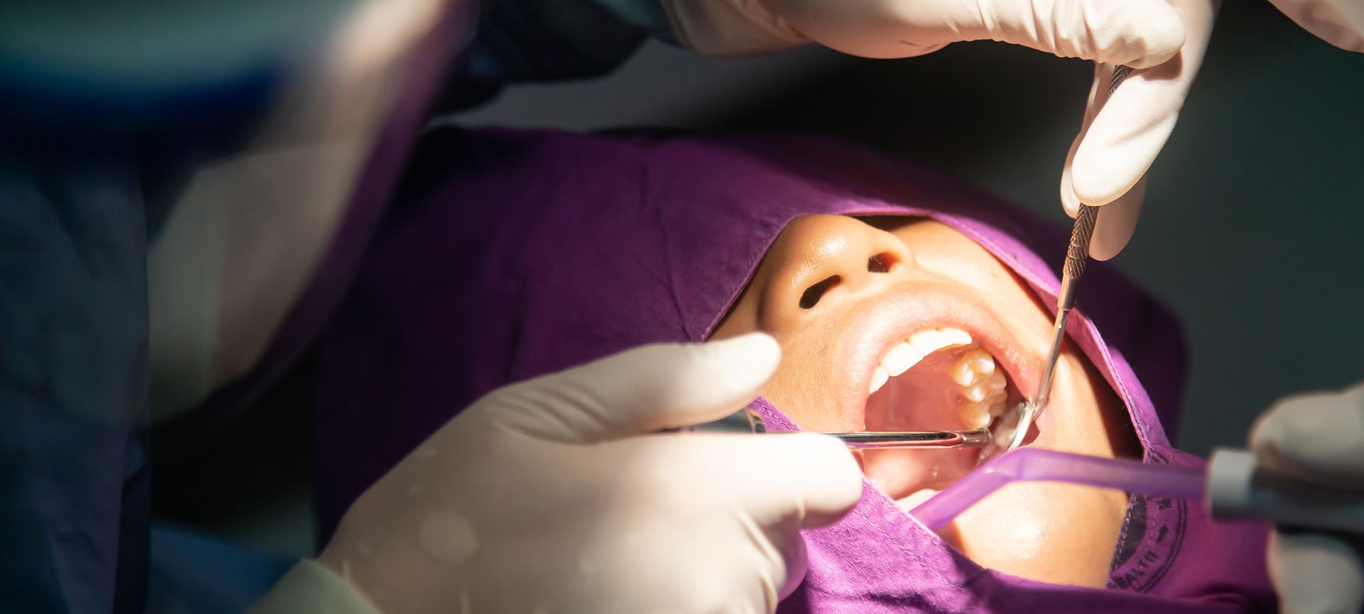 wisdom tooth removal