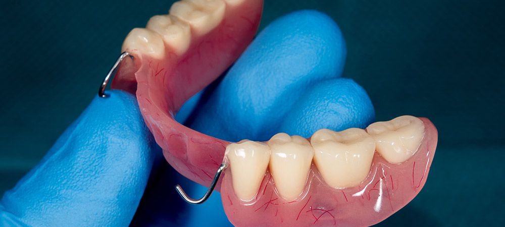 dental implants and partial denture