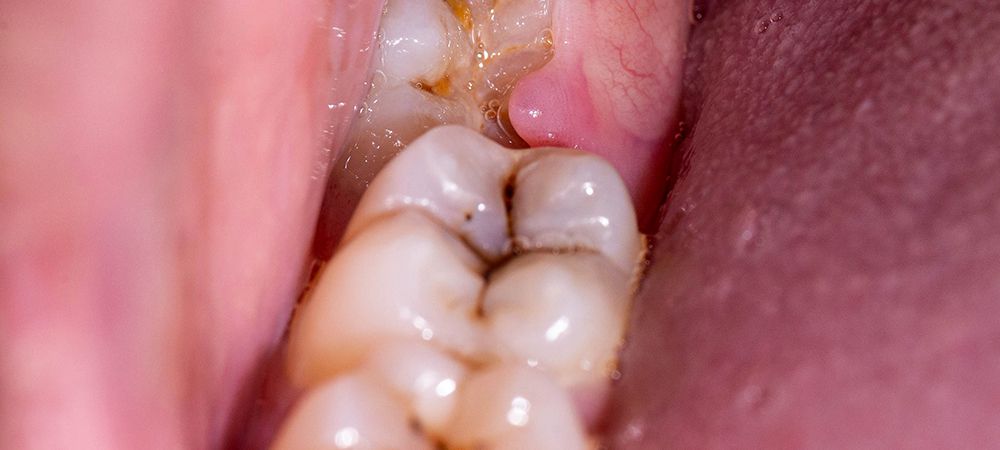 cost of wisdom tooth removal