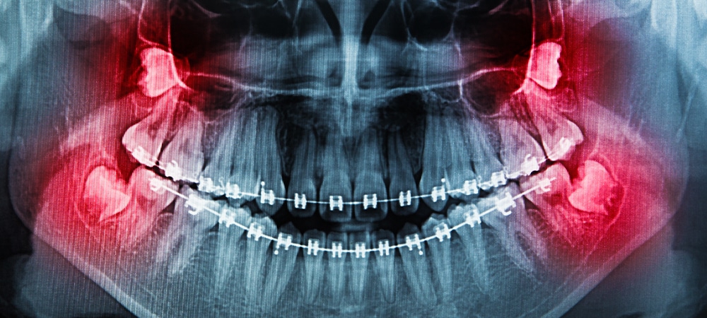 number of wisdom teeth