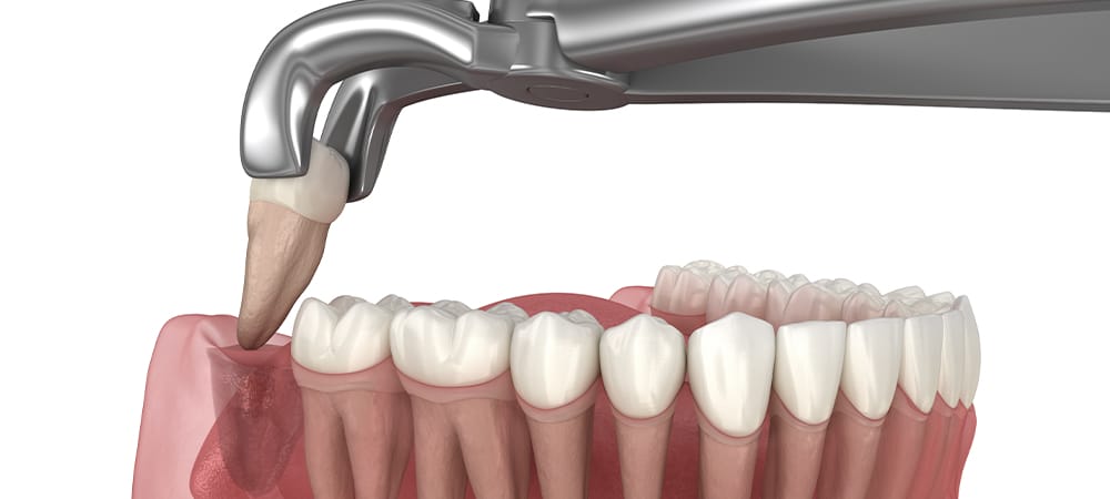 wisdom tooth removal