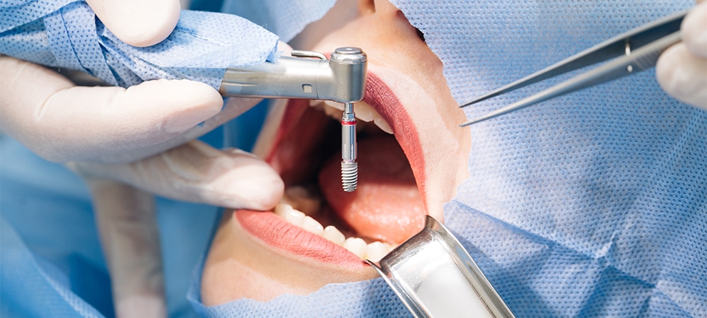 implants placed into jawbone