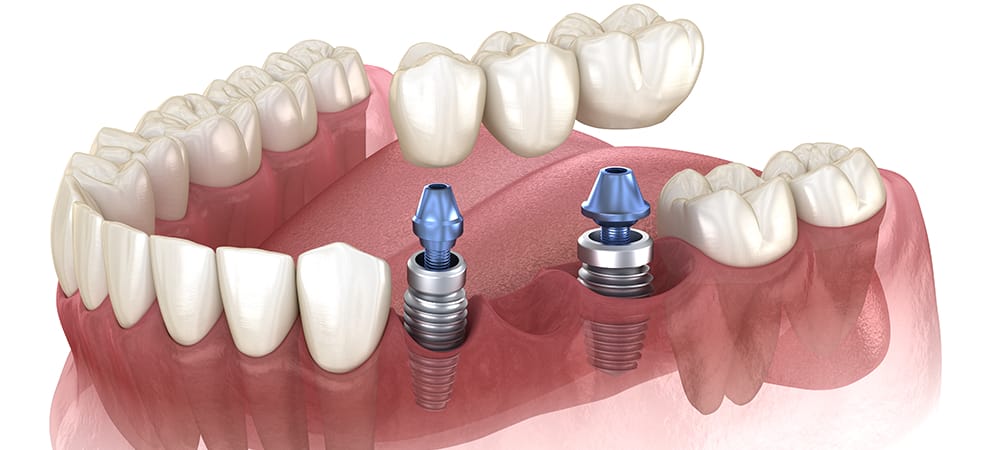 dental bridge cost