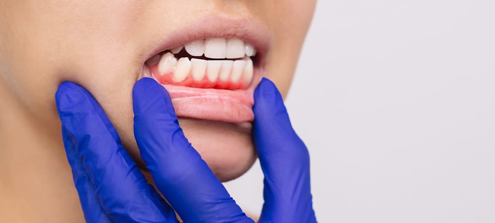 dental gum disease