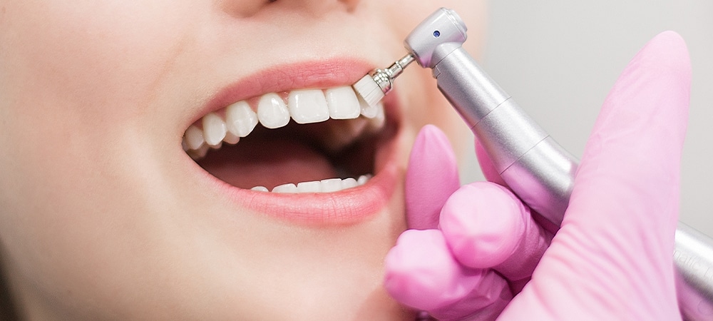 teeth polishing
