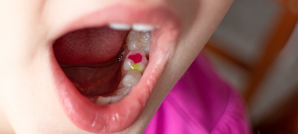 tooth-coloured fillings