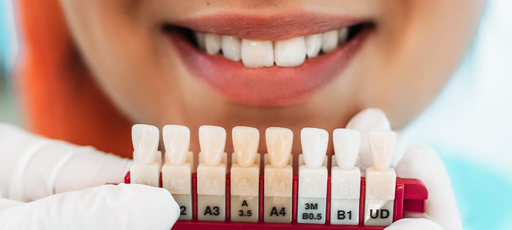 tooth-coloured restorations