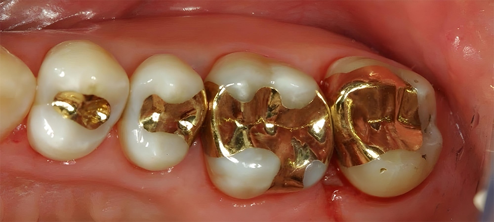tooth inlays and onlays