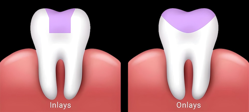 what is teeth inlays and onlays