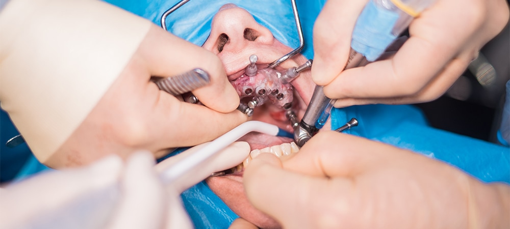 full mouth implants process