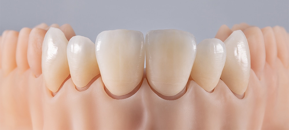 Six ceramic crowns on silicone gums. Dental model of teeth front view.