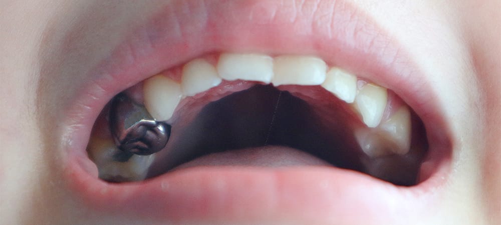 Close up child tooth with crown filling
