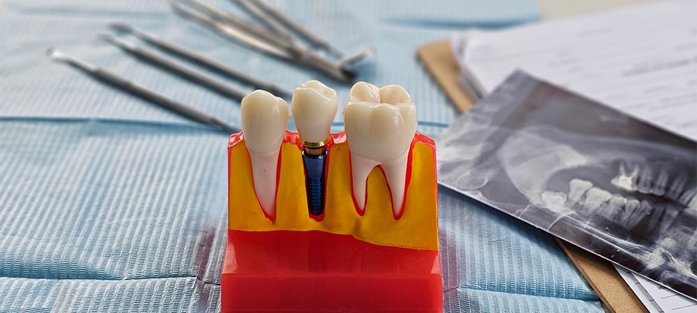 dental implant, artificial tooth roots into jaw