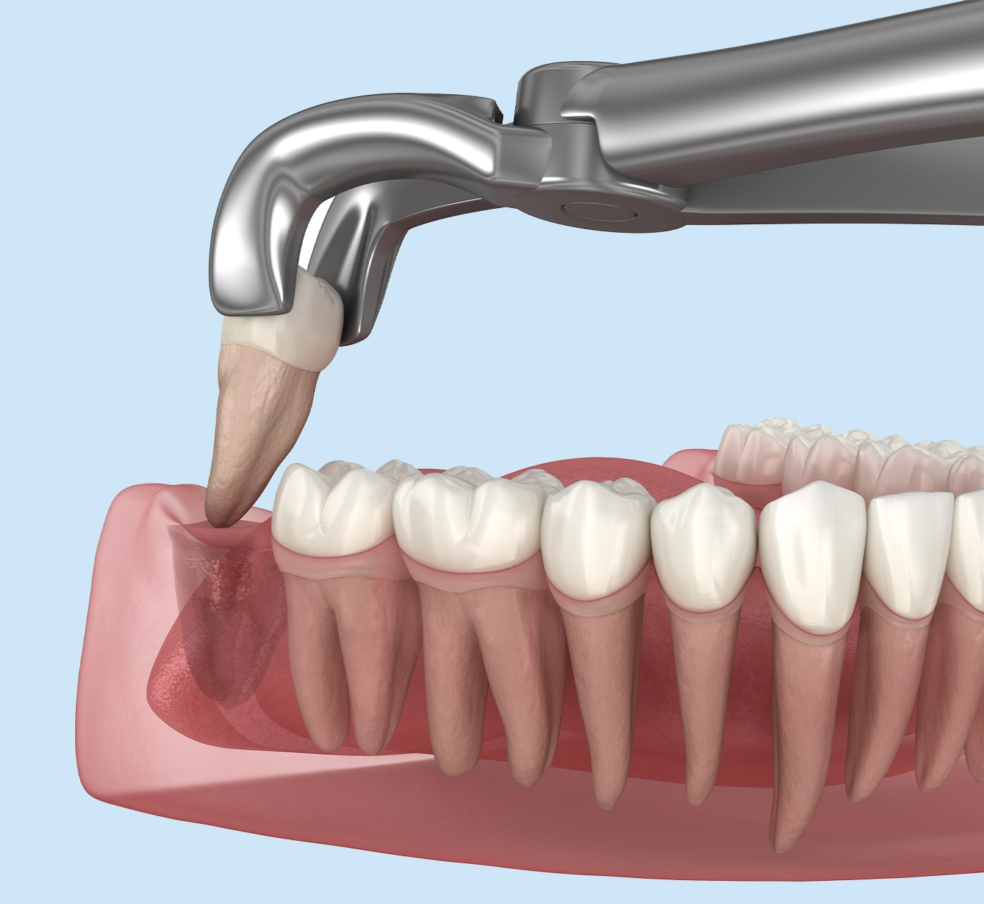 Extraction of wisdom tooth. Medically accurate tooth 3D illustration.